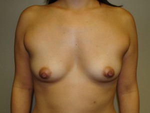Breast Augmentation Before and After 314 | Sanjay Grover MD FACS