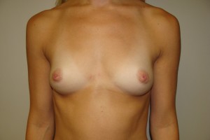 Breast Augmentation Before and After 84 | Sanjay Grover MD FACS