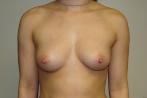 Breast Augmentation Before and After 56 | Sanjay Grover MD FACS