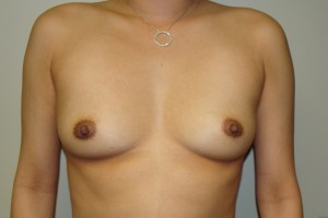 Breast Augmentation Before and After 122 | Sanjay Grover MD FACS