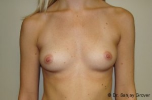 Breast Augmentation Before and After 124 | Sanjay Grover MD FACS