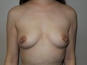 Breast Augmentation Before and After 87 | Sanjay Grover MD FACS