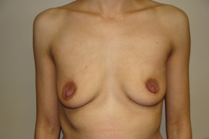 Breast Augmentation Before and After 114 | Sanjay Grover MD FACS