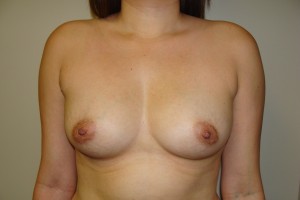 Breast Augmentation Before and After 205 | Sanjay Grover MD FACS