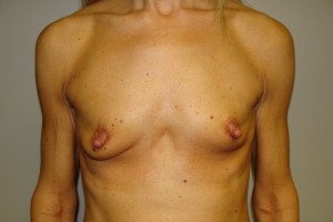 Breast Augmentation Before and After 111 | Sanjay Grover MD FACS