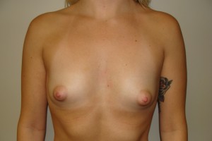 Breast Augmentation Before and After 190 | Sanjay Grover MD FACS