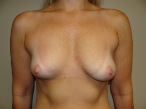 Breast Augmentation Before and After 208 | Sanjay Grover MD FACS