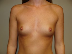 Breast Augmentation Before and After 301 | Sanjay Grover MD FACS