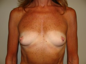 Breast Augmentation Before and After 65 | Sanjay Grover MD FACS