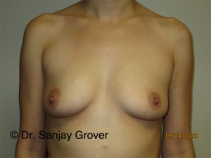 Breast Augmentation Before and After 06 | Sanjay Grover MD FACS