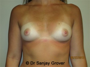 Breast Augmentation Before and After 232 | Sanjay Grover MD FACS