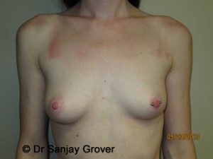 Breast Augmentation Before and After 140 | Sanjay Grover MD FACS
