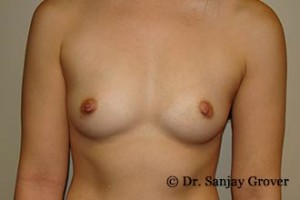 Breast Augmentation Before and After 314 | Sanjay Grover MD FACS