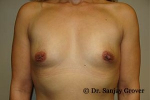 Breast Augmentation Before and After 239 | Sanjay Grover MD FACS