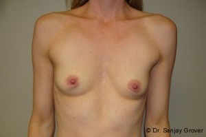 Breast Augmentation Before and After 16 | Sanjay Grover MD FACS
