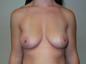 Breast Augmentation Before and After 282 | Sanjay Grover MD FACS