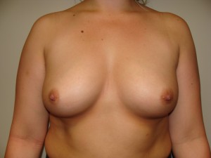 Breast Augmentation Before and After 230 | Sanjay Grover MD FACS