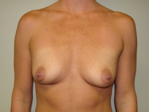 Breast Augmentation Before and After 119 | Sanjay Grover MD FACS