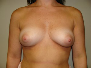 Breast Augmentation Before and After 143 | Sanjay Grover MD FACS