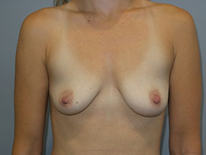 Breast Augmentation Before and After 252 | Sanjay Grover MD FACS