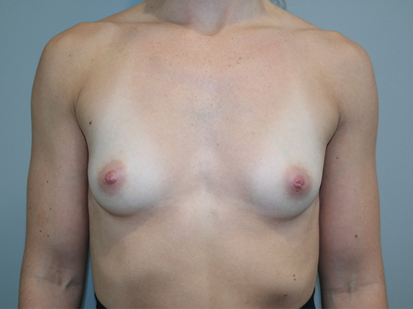 Breast Augmentation Before and After 167 | Sanjay Grover MD FACS