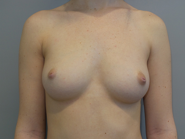 Breast Augmentation Before and After 152 | Sanjay Grover MD FACS