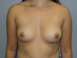 Breast Augmentation Before and After 209 | Sanjay Grover MD FACS