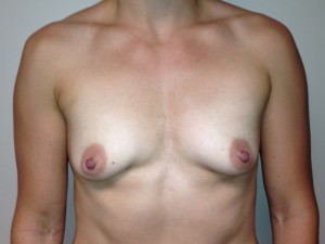 Breast Augmentation Before and After 01 | Sanjay Grover MD FACS