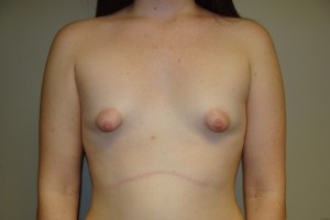 Breast Augmentation Before and After 218 | Sanjay Grover MD FACS