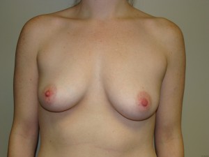 Breast Augmentation Before and After 216 | Sanjay Grover MD FACS