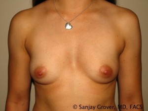 Breast Augmentation Before and After 28 | Sanjay Grover MD FACS
