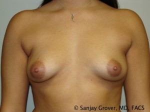 Breast Augmentation Before and After 195 | Sanjay Grover MD FACS