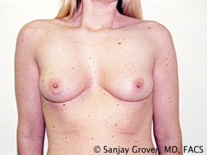 Breast Augmentation Before and After 118 | Sanjay Grover MD FACS