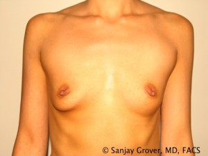 Breast Augmentation Before and After 40 | Sanjay Grover MD FACS