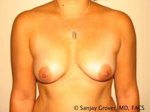 Breast Augmentation Before and After 258 | Sanjay Grover MD FACS