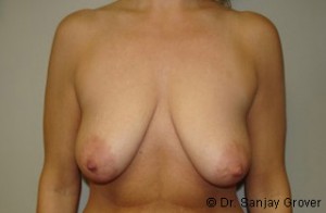 Breast Lift Before and After 14 | Sanjay Grover MD FACS