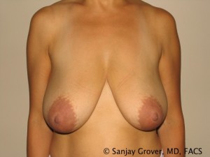 Breast Reduction Before and After 22 | Sanjay Grover MD FACS