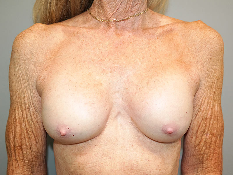 Breast Revision Before and After 27 | Sanjay Grover MD FACS