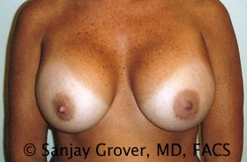 Breast Revision Before and After 14 | Sanjay Grover MD FACS
