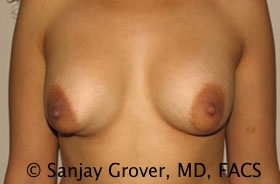 Breast Revision Before and After 15 | Sanjay Grover MD FACS