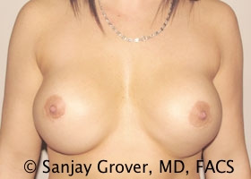 Breast Revision Before and After 55 | Sanjay Grover MD FACS