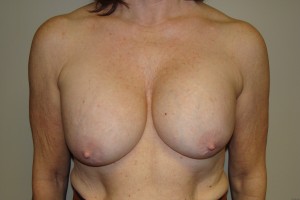 Breast Revision Before and After 38 | Sanjay Grover MD FACS