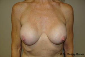 Breast Revision Before and After 09 | Sanjay Grover MD FACS