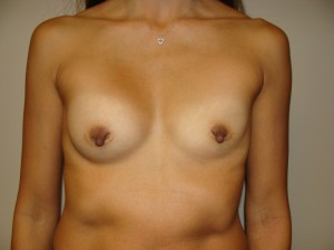 Breast Revision Before and After 09 | Sanjay Grover MD FACS