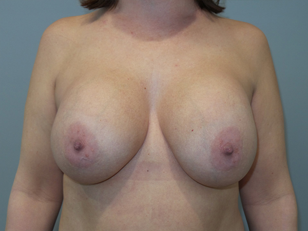 Breast Revision Before and After 02 | Sanjay Grover MD FACS