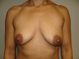 Mini Breast Lift Before and After 20 | Sanjay Grover MD FACS