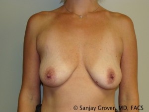 Mini Breast Lift Before and After 07 | Sanjay Grover MD FACS