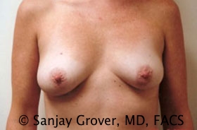 Mini Breast Lift Before and After 26 | Sanjay Grover MD FACS