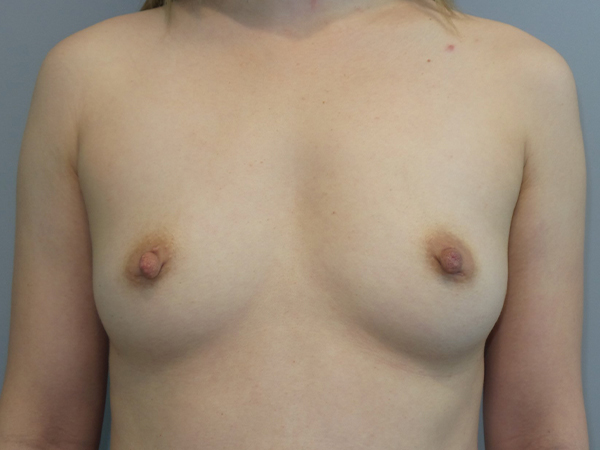 Scarless Breast Augmentation Before and After 09 | Sanjay Grover MD FACS