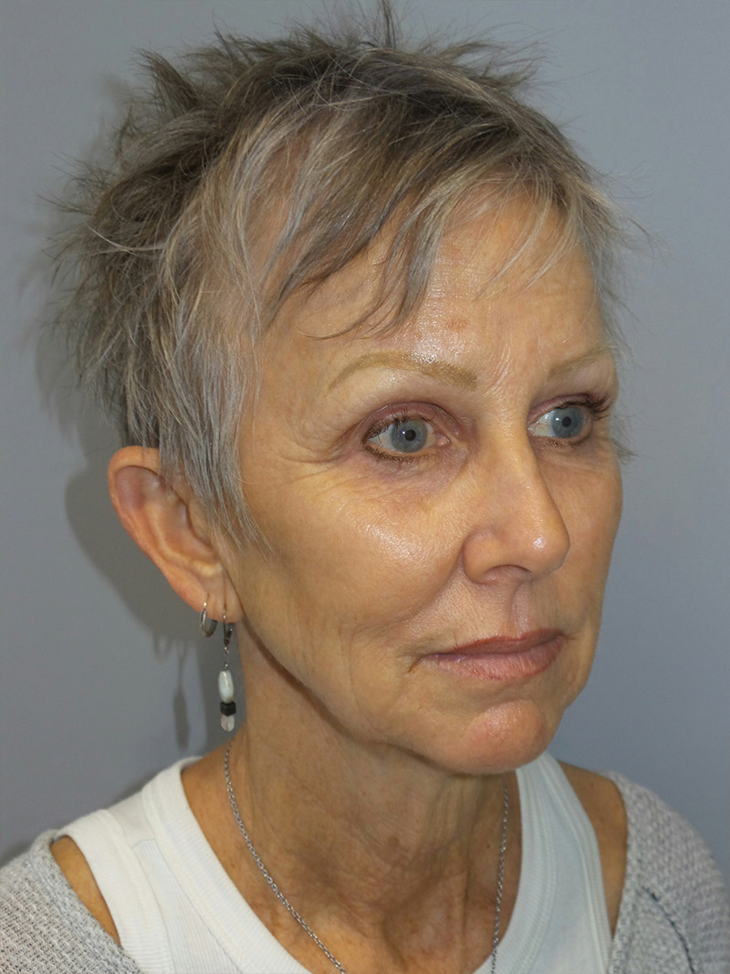 Facelift Before and After 30 | Sanjay Grover MD FACS